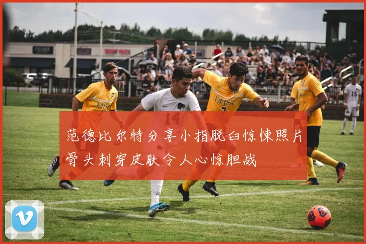 范德比尔特分享小指脱臼惊悚照片骨头刺穿皮肤令人心惊胆战